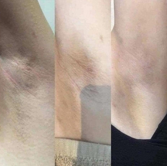 Underarm Whitening Set - Picture 2 of 2